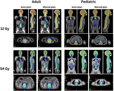 Automated contouring, treatment planning, and quality assurance for VMAT craniospinal irradiation (VMAT-CSI)